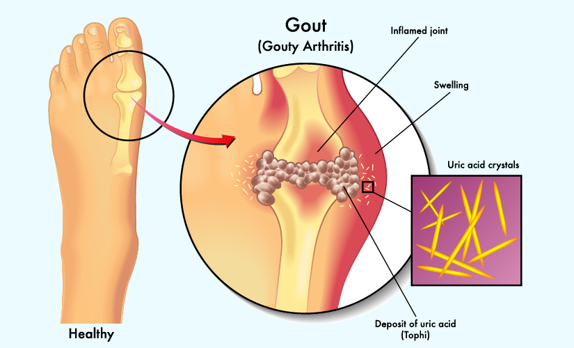 uric acid symptoms1